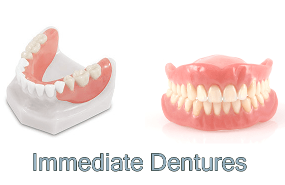 Immediate Dentures - Ardent Smile
