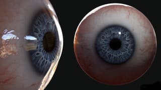 Glossop Ocular Prosthetics Custom Iris Prosthesis