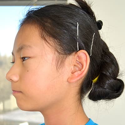 Custom Prosthetic, Ltd. | Gallery of ear prosthetics