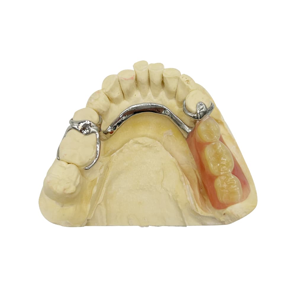 Vitallium Dentures | Precision Partial Frameworks by Istar