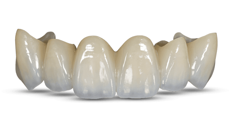 BruxZir Zirconia Cantilever Bridge (Glidewell)