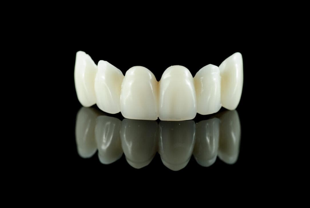 Lava Plus High Translucency Zirconia Cantilever Bridge