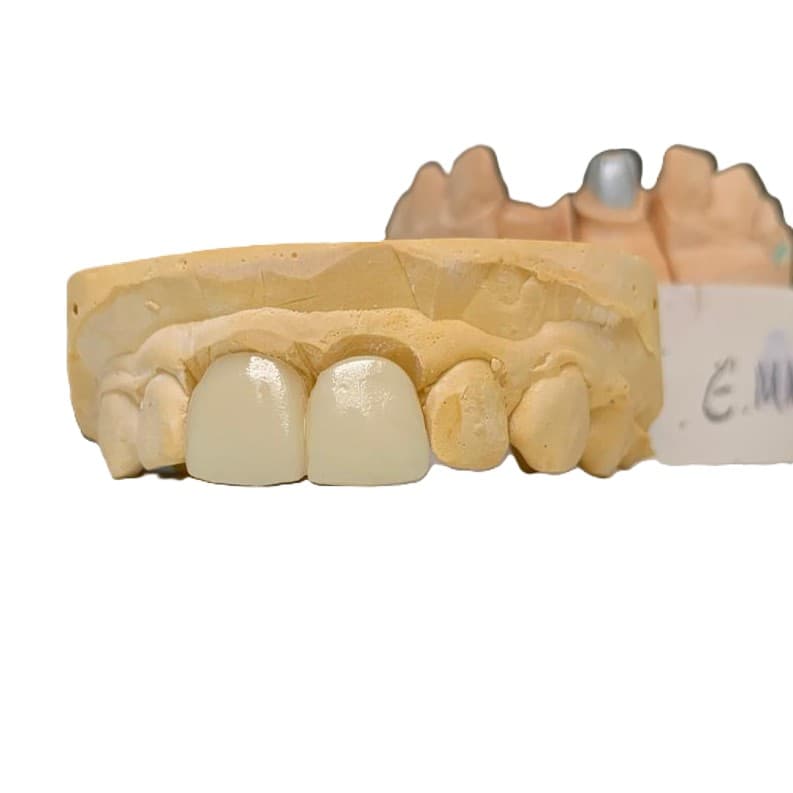 IPS e.max Press Cantilever Bridge