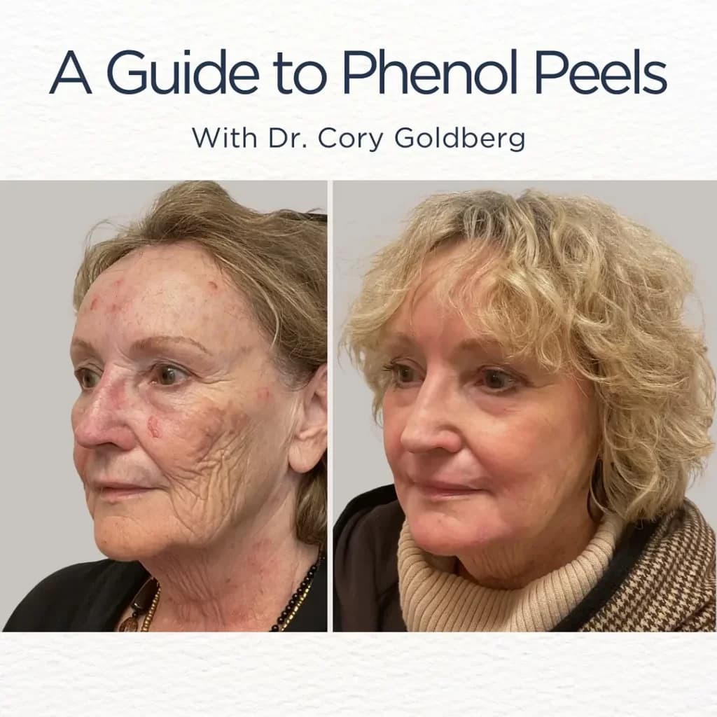 Phenol Peel Before and After - Before After Jour…