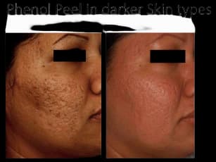 Enerpeel PA Phenol Peel