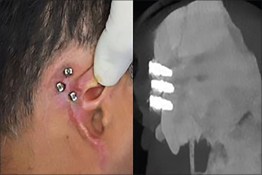 Rehabilitation of Auricular Defect with Implant-Retained Auricular ...