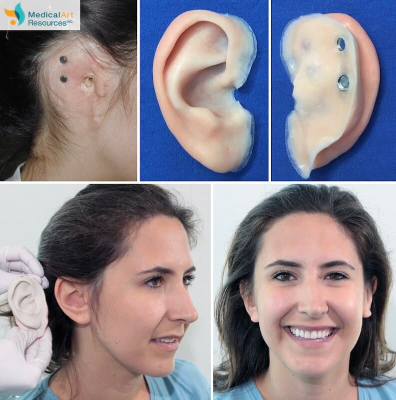Ear Prosthesis Photos | Medical Art Resources — Life-like Prosthetics