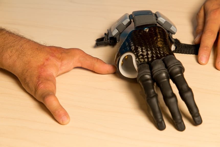 Finger and Partial Hand Prosthetic Options | Arm Dynamics