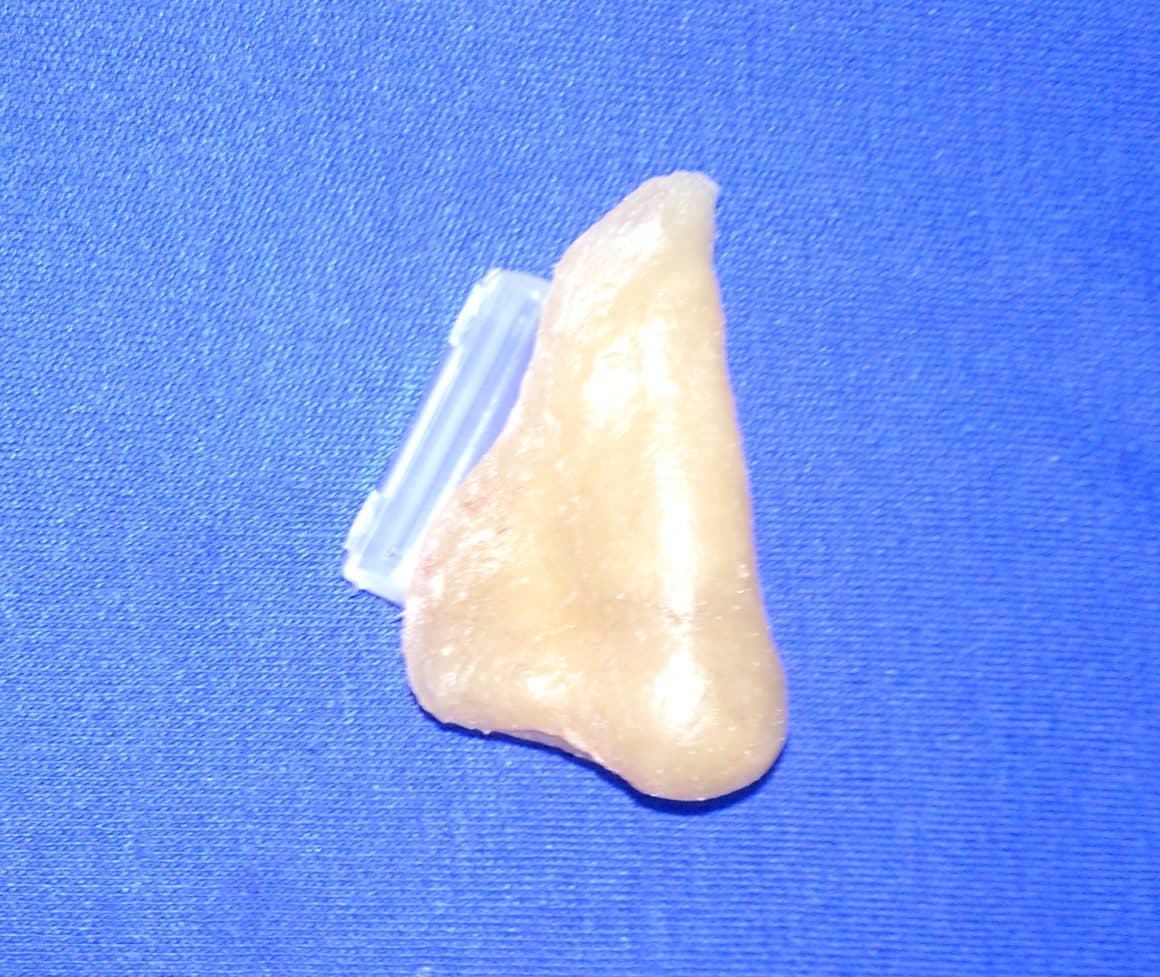 Technovent Nasal Prosthesis