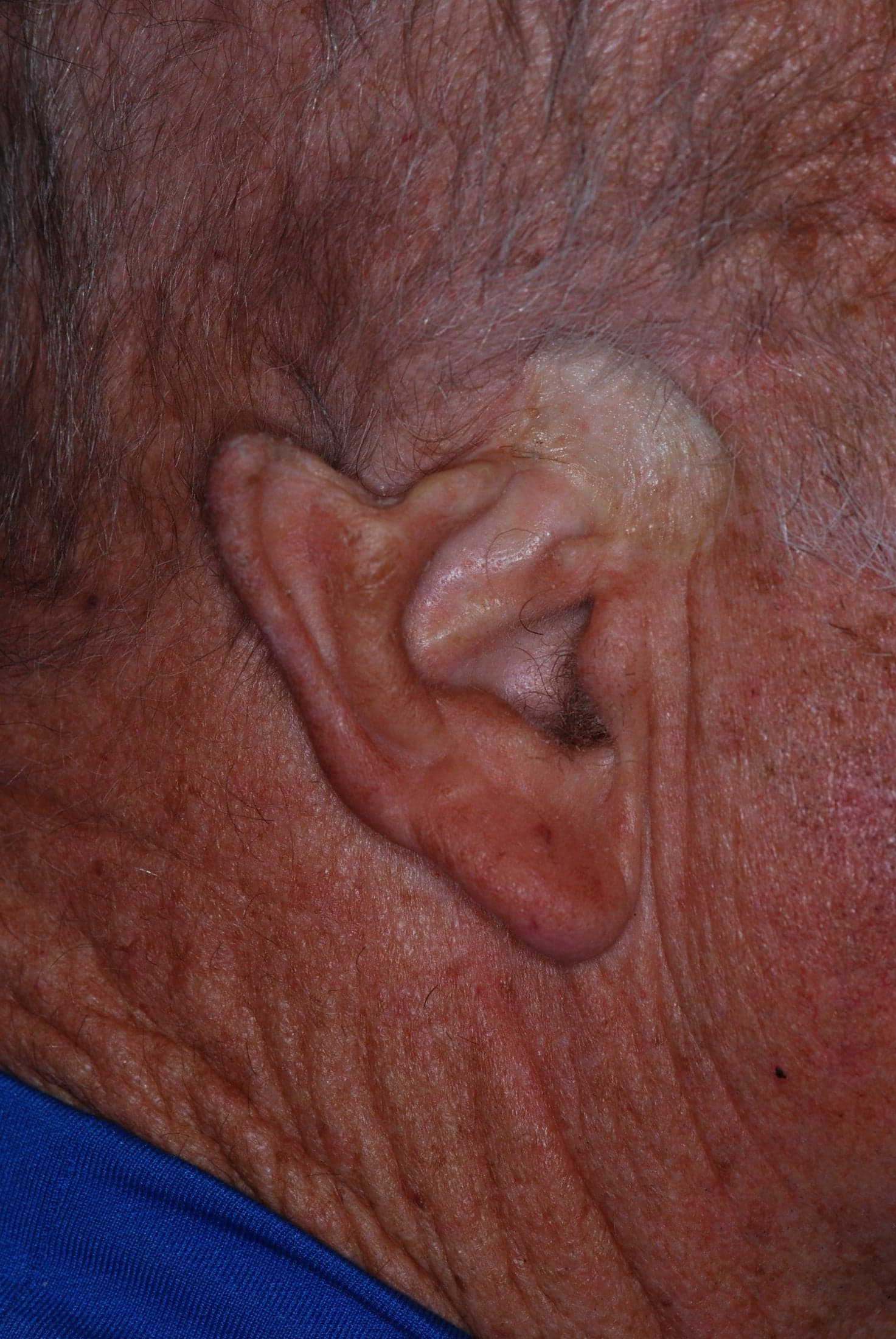 Fripp Design Living Skin Ear Prosthesis