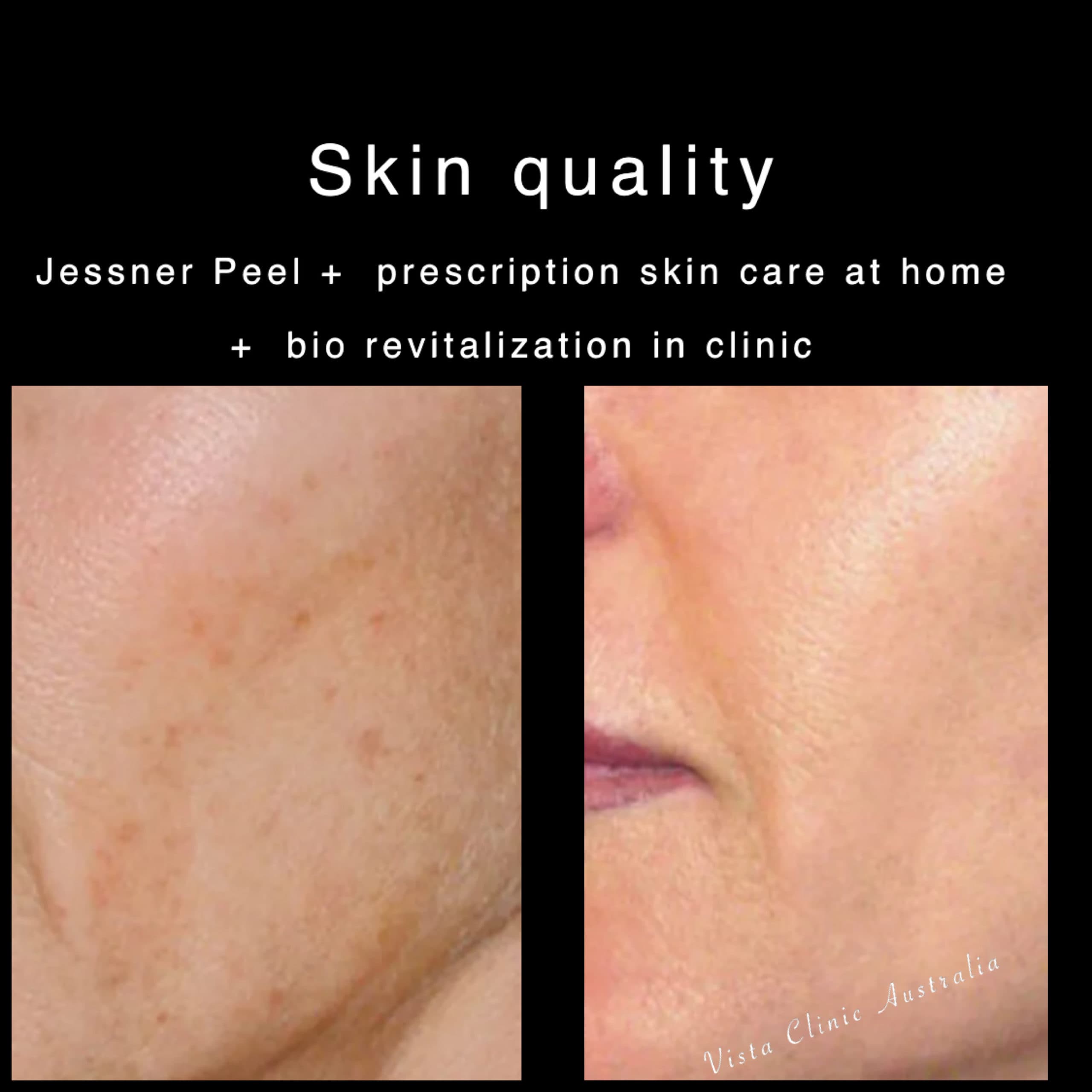 Jessner Peel Aftercare Instructions at Edward Padgett blog
